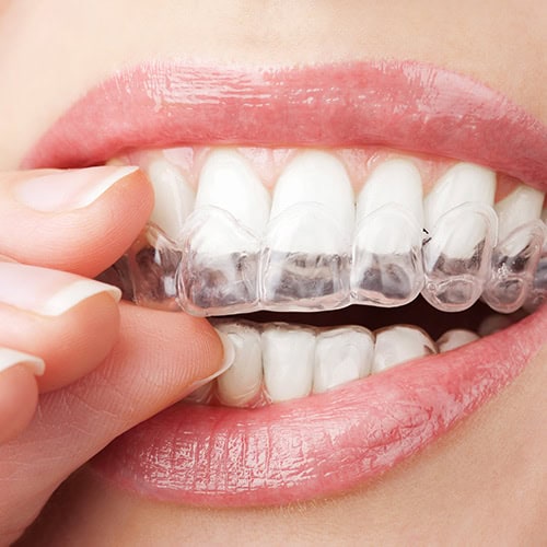 Custom Invisible Mouth Guard