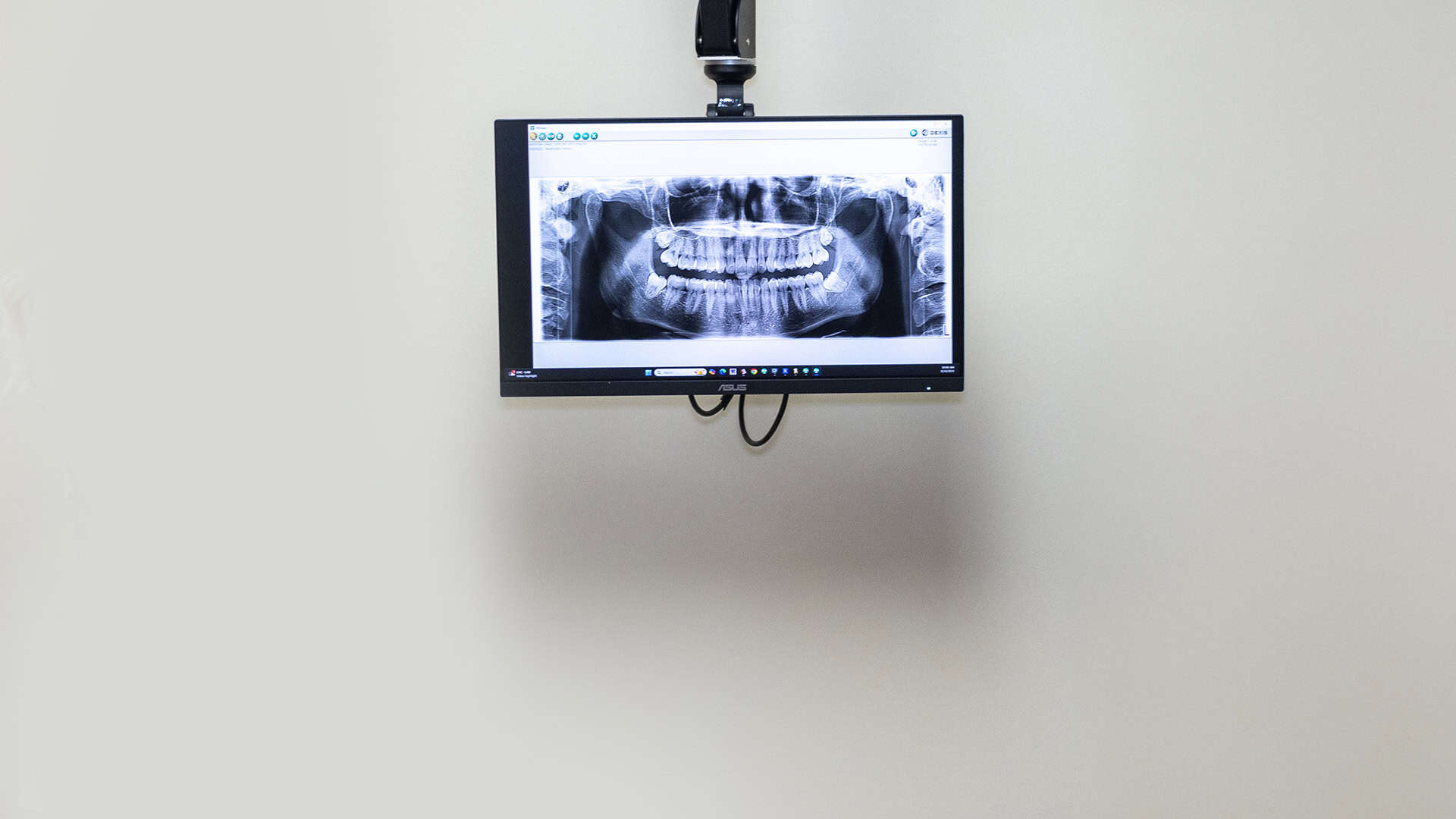 Fillings X-Ray