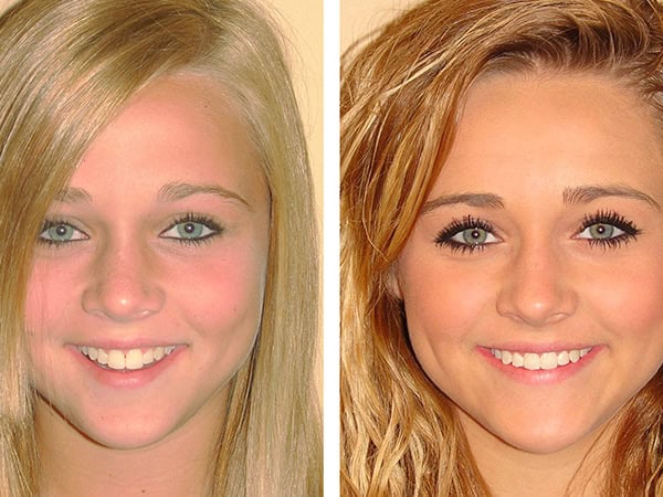 Teenager Before and After Invisalign