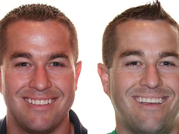 Man Before and After Invisalign