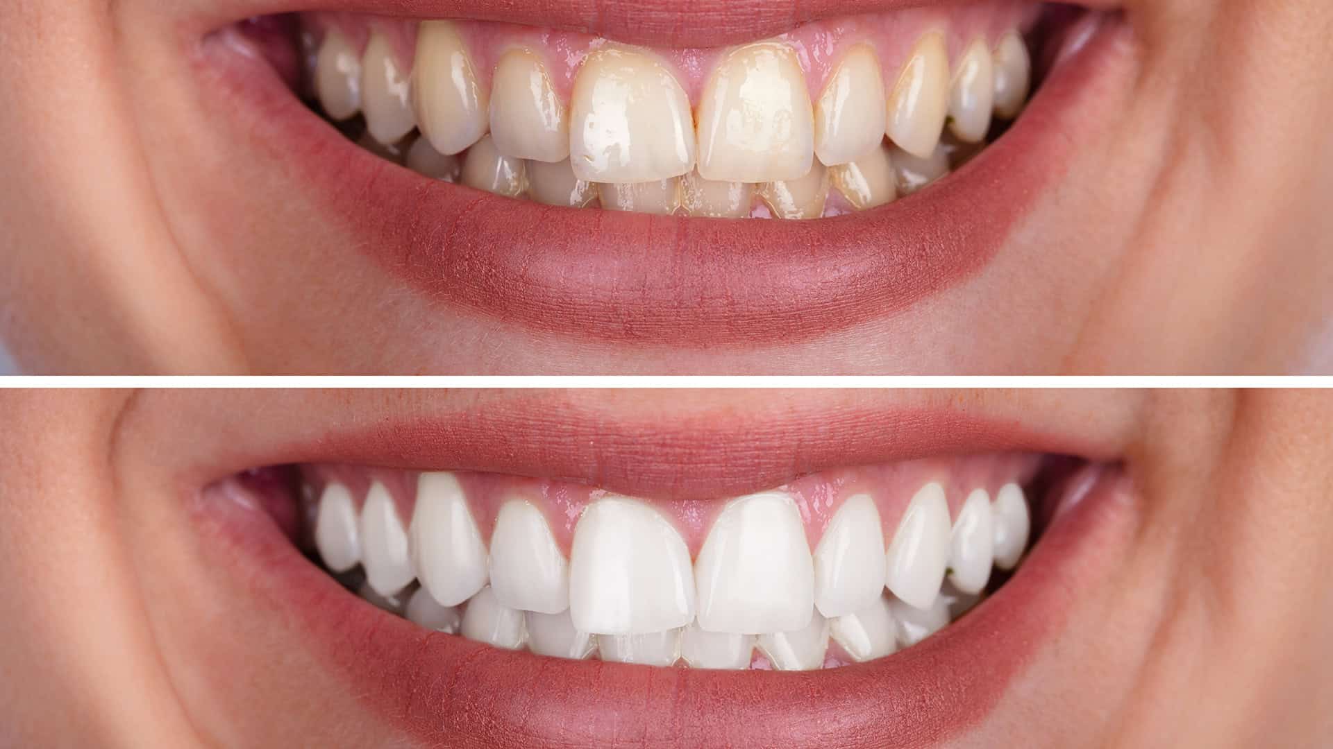 Before and After Teeth Whitening